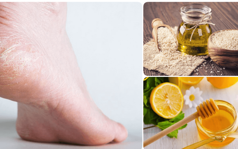 Trị nứt gót chân bằng bột gạo, mật ong và giấm