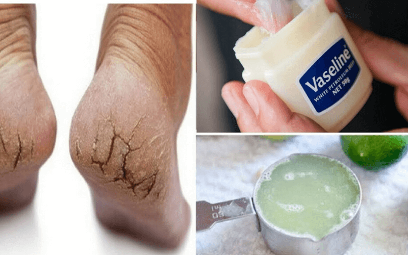 Trị nứt gót chân bằng Vaseline kết hợp với nước chanh